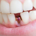 zęby z implantem